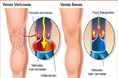 INNOVADOR TRATAMIENTO PARA PREVENIR VÁRICES EN  BASE A HOJAS DE UVA ROJA CHILENA.