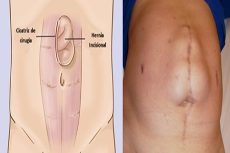 Hernia inguinal: Una patología frecuente de fácil solución.