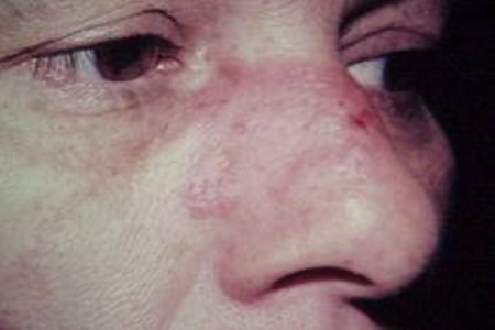 ¿Constantes cambios de salud? ¡Cuidado! Podrías tener Vasculitis.