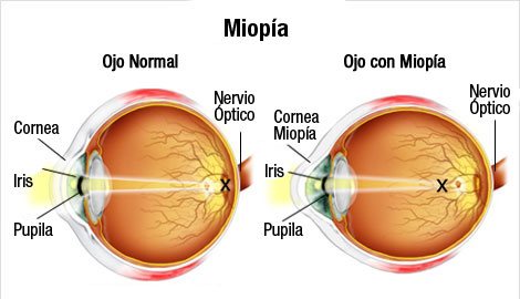 ¡Atención! Esto es lo que tienes que saber si quieres usar lentes de contacto.