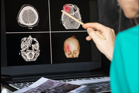 La detección temprana del infarto cerebrovascular: clave para salvar vidas.